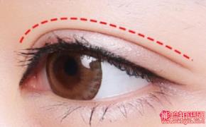 双眼皮种类 双眼皮有几种种类