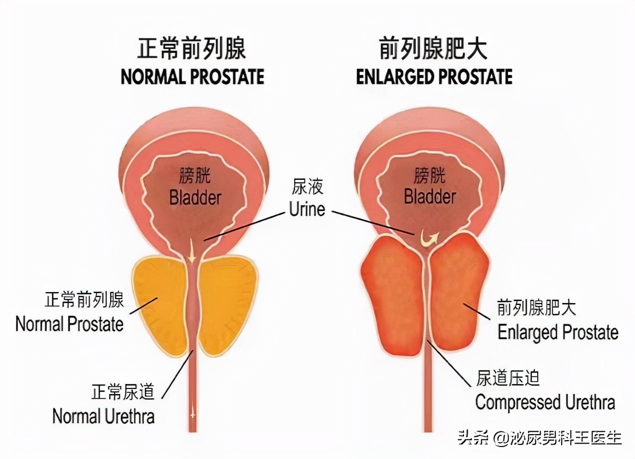 19岁有前列腺炎是不是玩完了的简单介绍