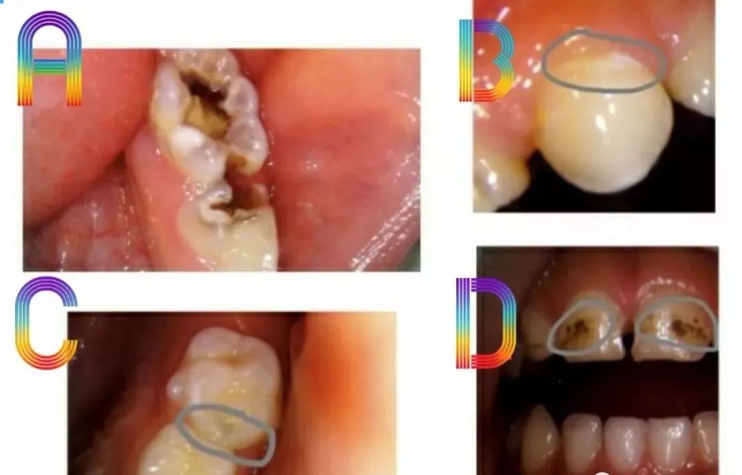 大牙蛀牙已经烂空了用拔吗(大牙蛀牙已经烂空了用拔吗治疗后一直疼)