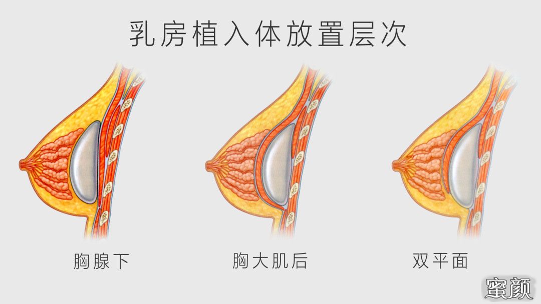 假体隆胸可以放一辈子吗(假体隆胸可以永久放在身体里面)