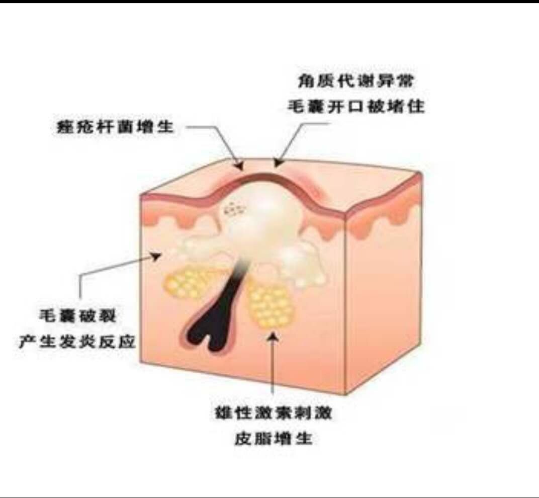 治疗青春痘的最佳方法(治疗青春痘最有效的药物是什么药)