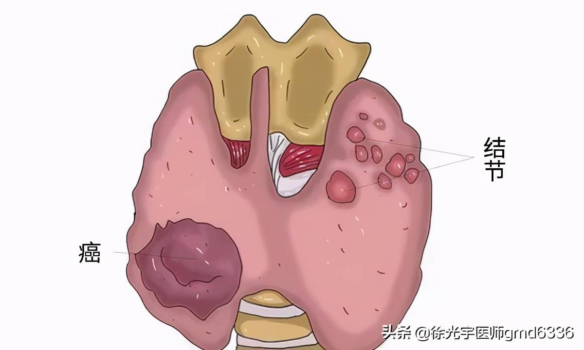 甲状腺结节会自愈吗(三类甲状腺结节会自愈吗)