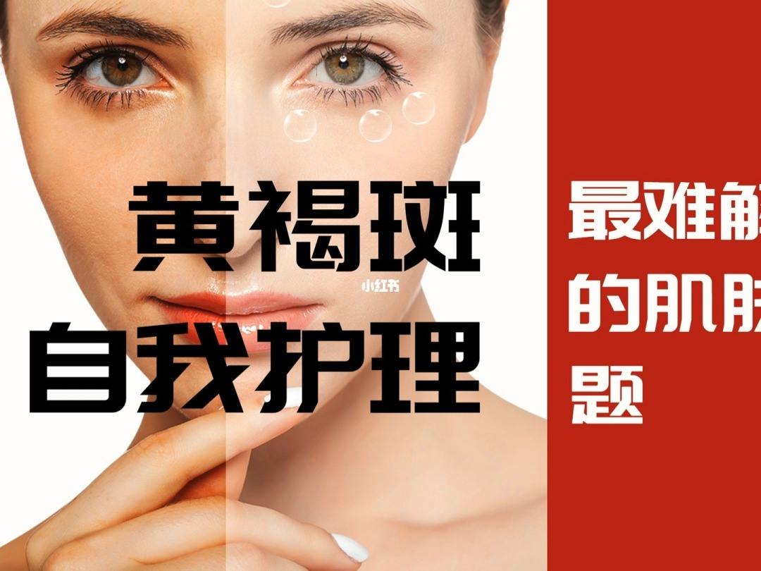 黄褐斑是怎么形成的(中医讲黄褐斑是怎么形成的)