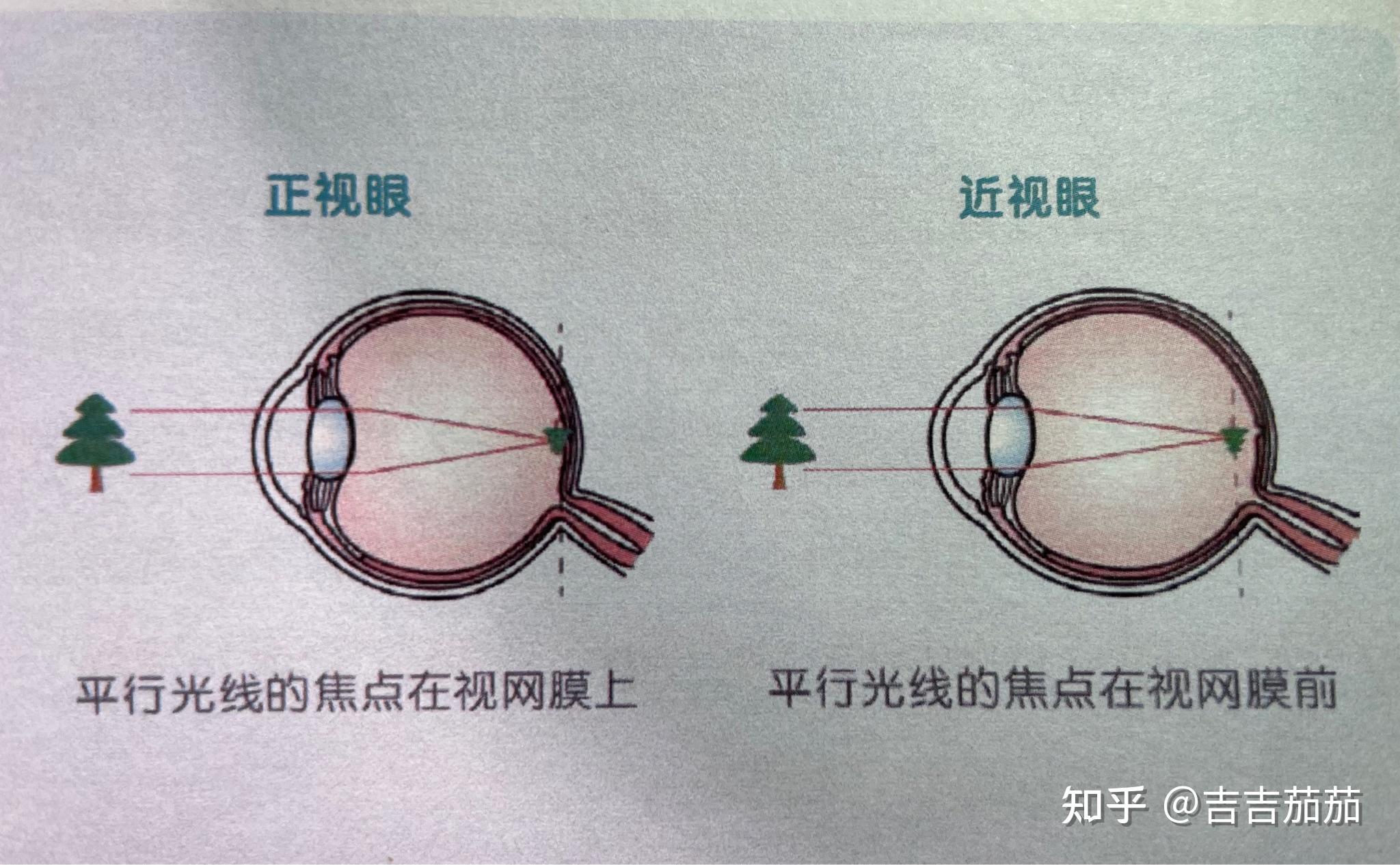 真性近视竟然恢复了(做近视手术有风险和后遗症吗)