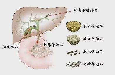 胆结石最佳治疗方法(多发性胆结石最佳治疗方法)